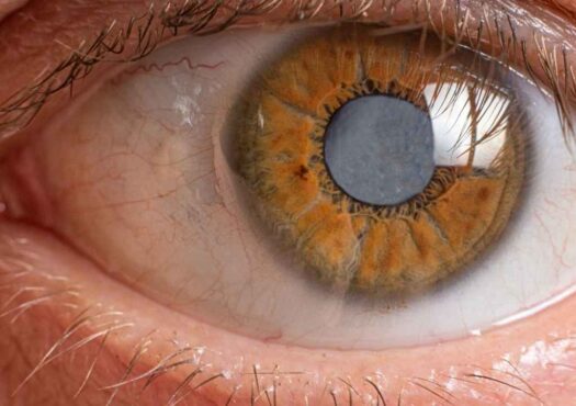 ئاوی سپی چاو: هۆکارەکان، نیشانەکانی، خۆپاراستن، چارەسەر