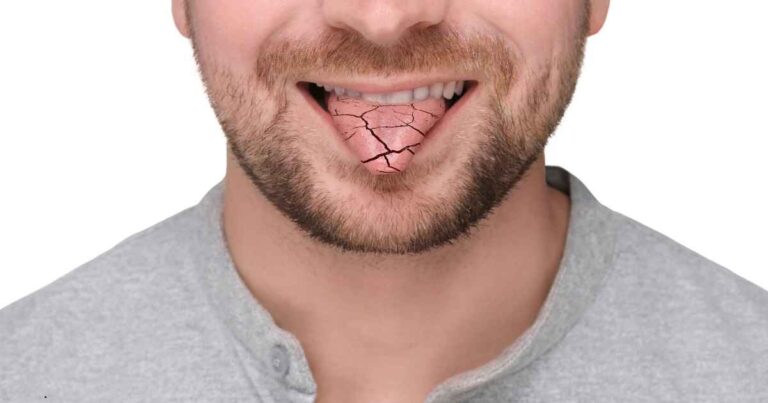 xerostomia xerostomia